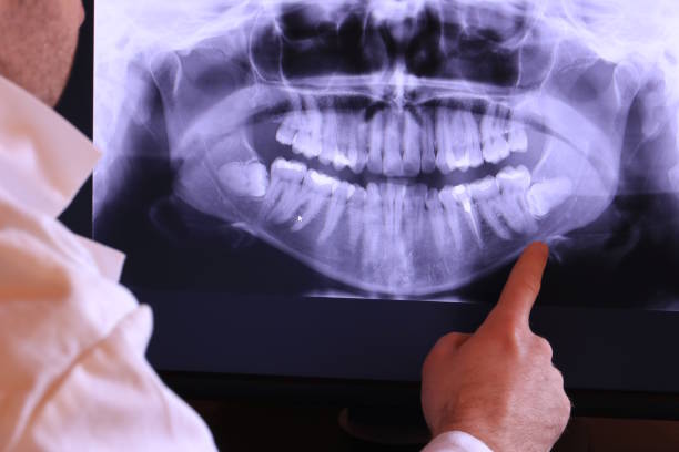 Best Emergency Wisdom Tooth Extraction in Simpson, PA